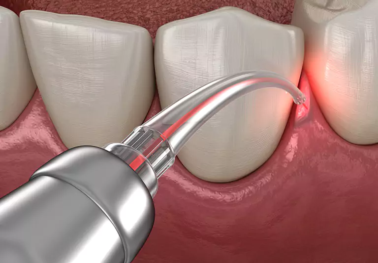 The Simple Ways Aesthetic Gum Correction Improves Your Smile